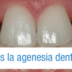 agenesia dental